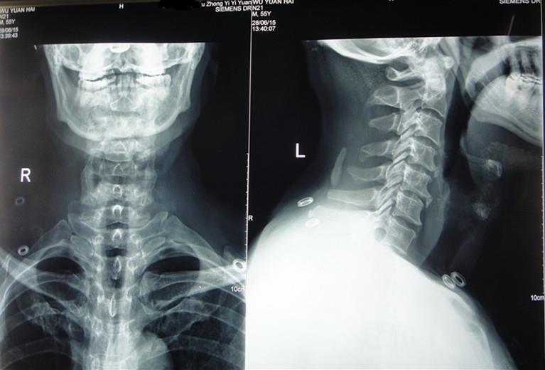 临床鉴定   2015年6月28日颈椎正侧位x线片    2015年8月12日颈椎mr片