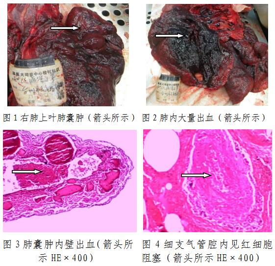 温州医科大学司法鉴定中心对涉外人员急性肺出血猝死当事人的法医病理