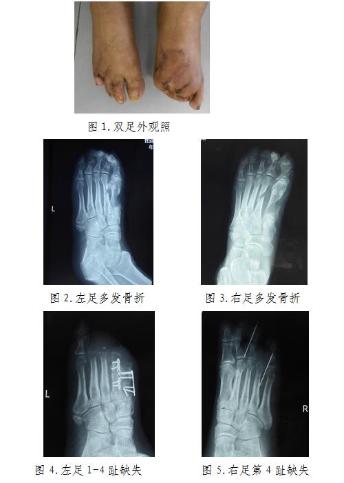 伴骨缺损后双足足趾截趾术后双足部分缺失伤残等级的法医临床鉴定案