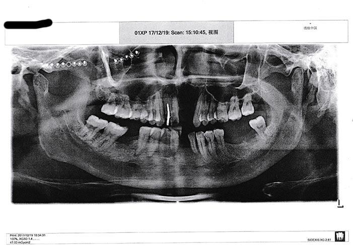 33～46牙松动,31,41牙脱落)伴对应上下颌牙槽骨骨折等,经治疗与恢复