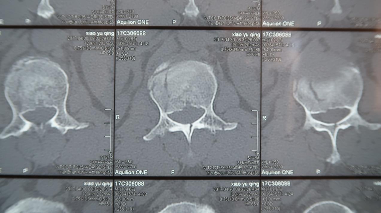 损伤致第1腰椎粉碎性骨折(椎管内骨性占位)并相应椎板及左侧横突骨折