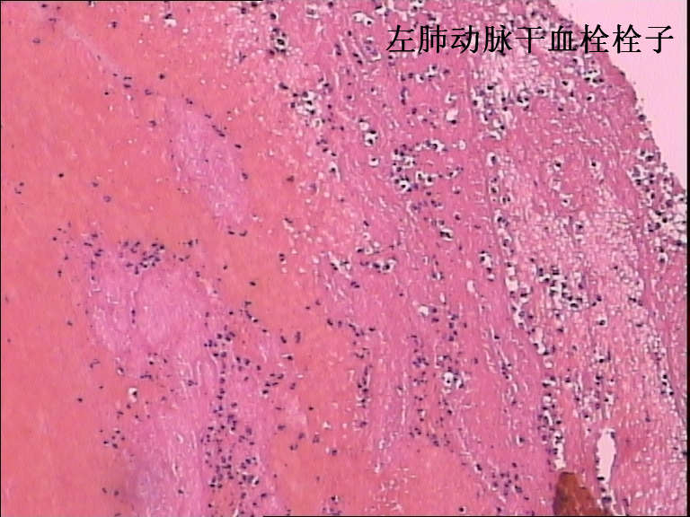 绵阳鼎立司法鉴定所 对肺动脉栓塞一例的法医病理鉴定(3月份录用)