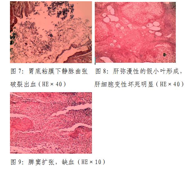 温州医科大学司法鉴定中心对肝硬化并发上消化道出血造成脑,肝功能