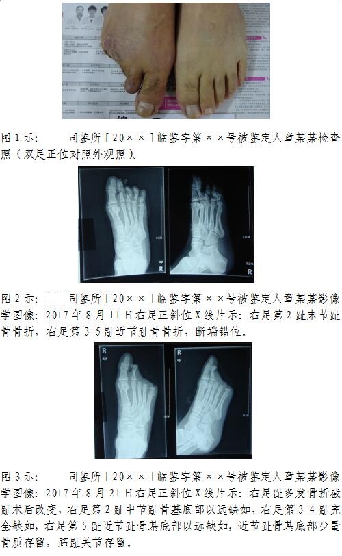 绍兴明鸿司法鉴定所对足趾损伤伤残程度的法医临床鉴定案