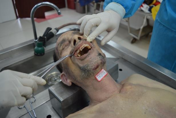 福建正扬司法鉴定所对孙必让死因法医学鉴定