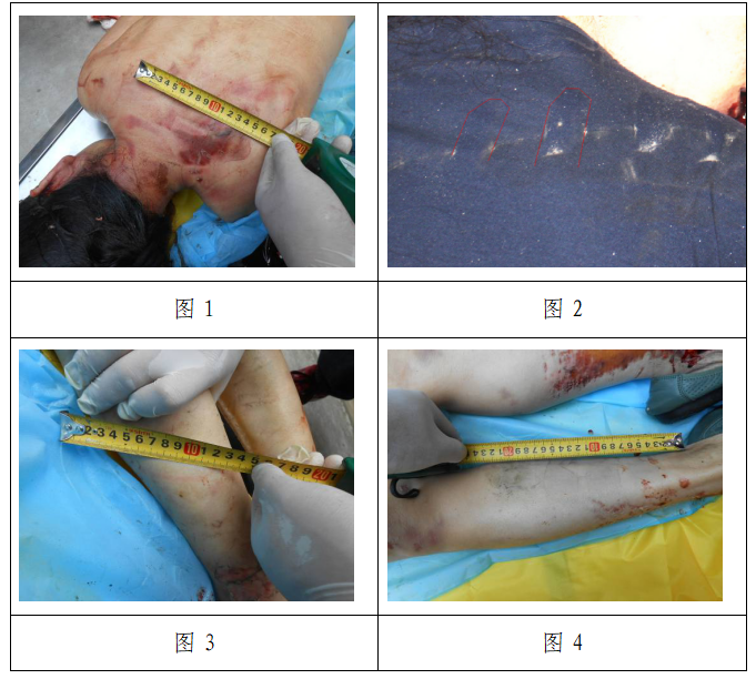 山东交院交通司法鉴定中心对受害人体表及衣物轮胎痕迹