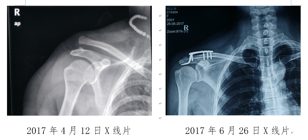 广东恒安法医临床司法鉴定所对交通事故受伤当事人的法医临床学鉴定