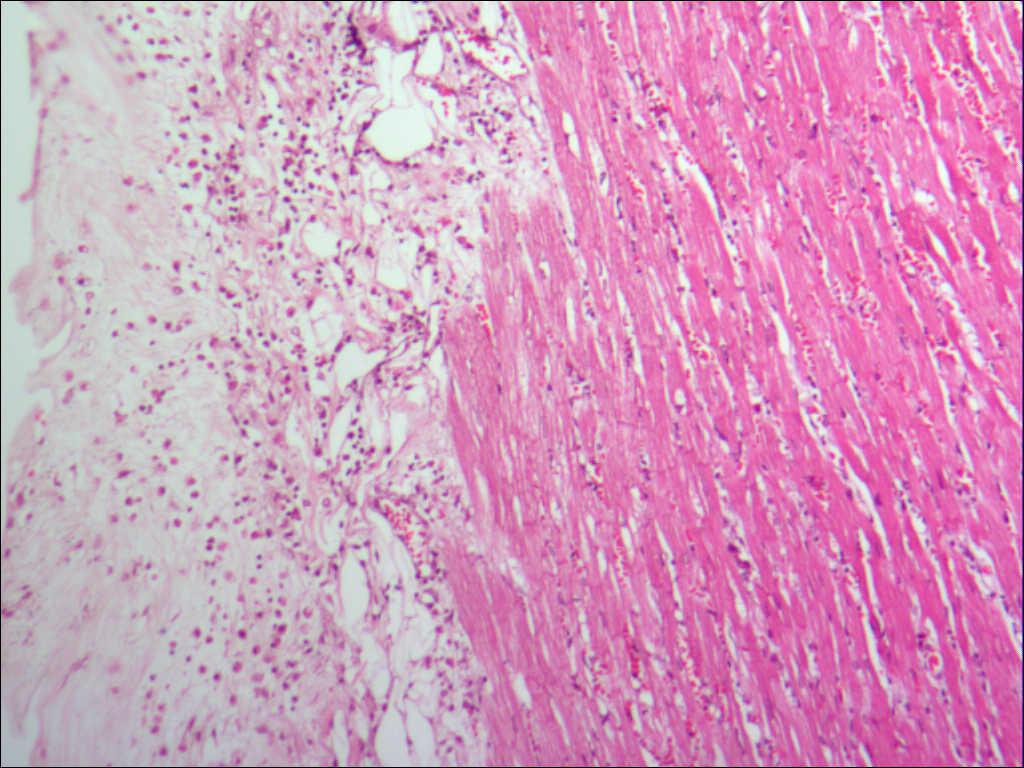 心外膜炎性细胞浸润