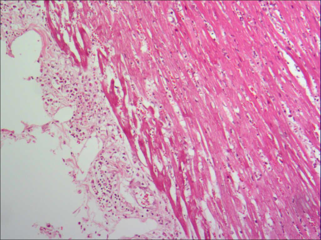 心外膜炎性细胞浸润
