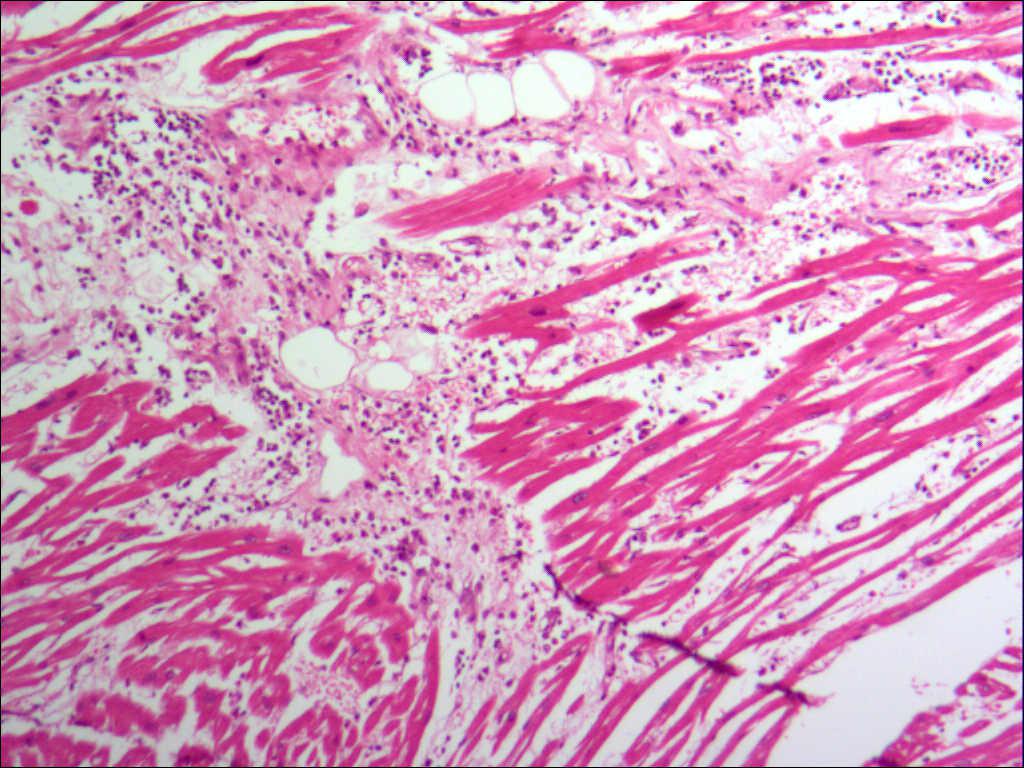 心肌間質炎性細胞浸潤