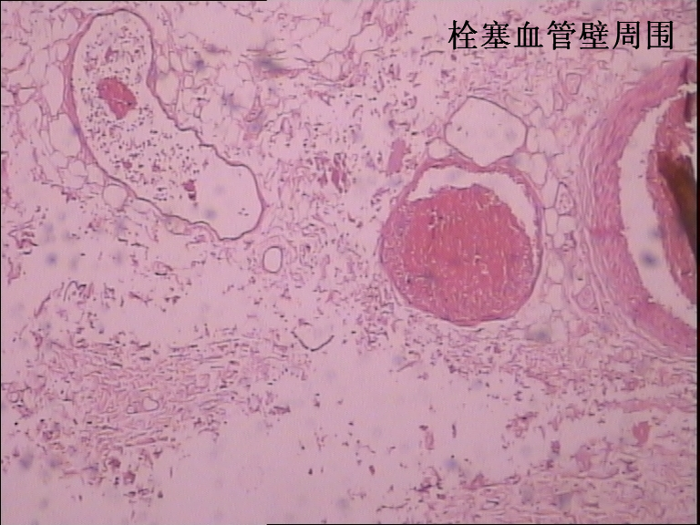 绵阳鼎立司法鉴定所 对肺动脉栓塞一例的法医病理鉴定(3月份录用)