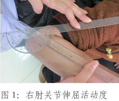 阅片所见:2017年9月24日××医院右肘x线片示:右肘关节间隙可,骨质