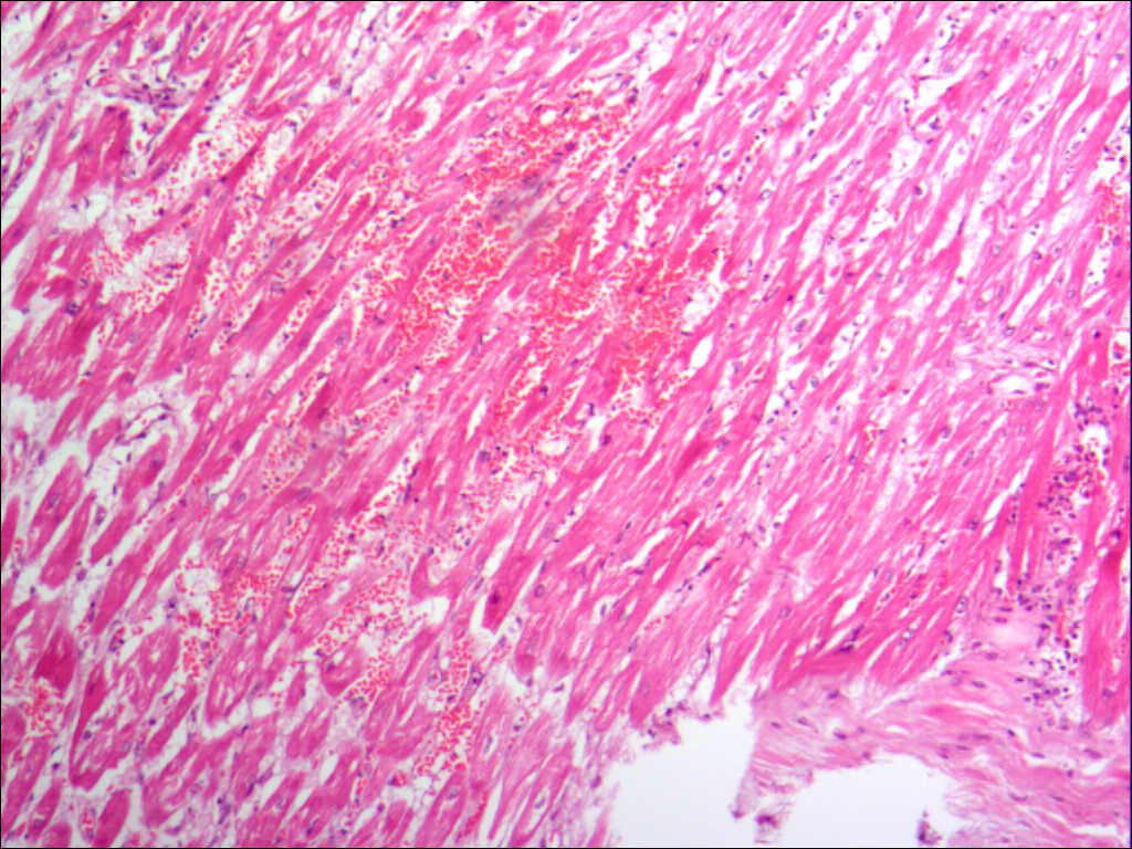 心肌间质炎性细胞浸润并出血